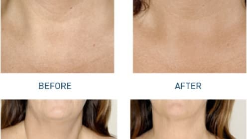 Mesotherapy