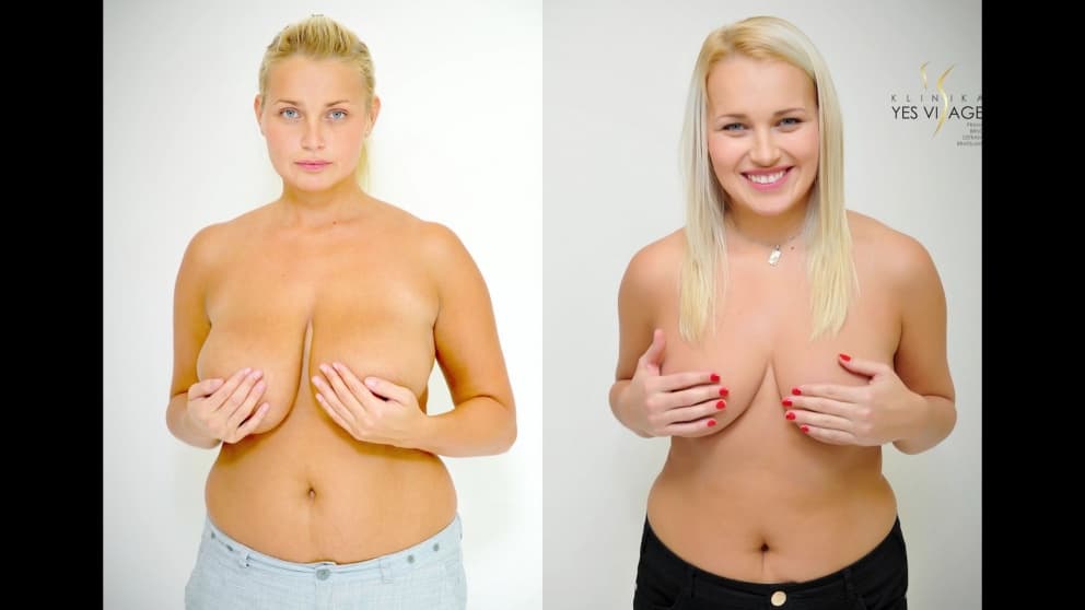 VIDEO TRANSFORMATION: Breast reduction