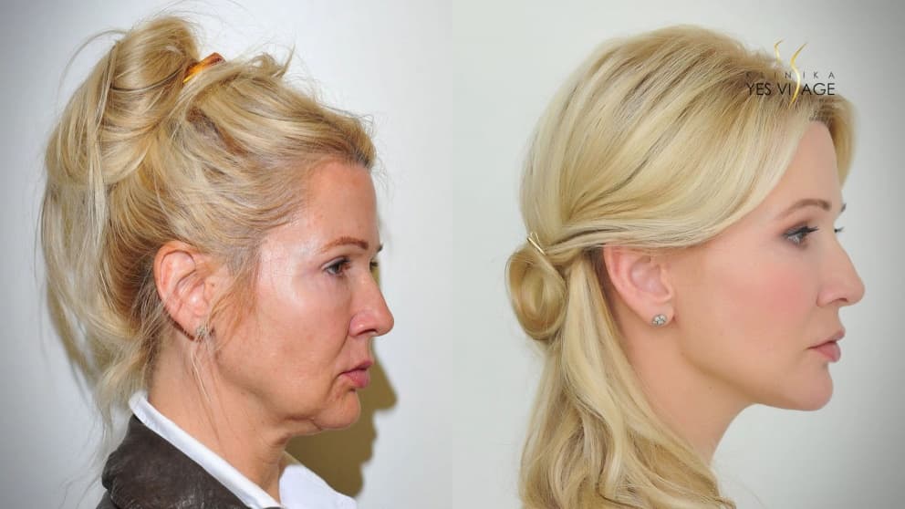 Niťový lifting, facelift - Lenka