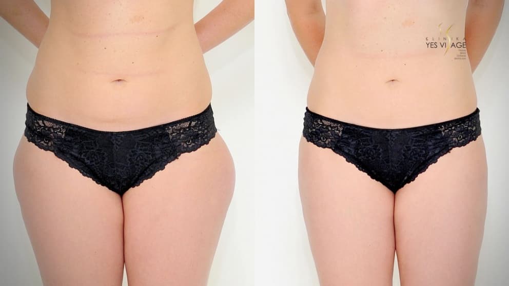 Lipotransfer - Fat transfer at YES VISAGE Clinic
